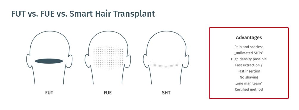 TissUse社(TissUse GmbH：テッシュ・ゲー・エム・ベー・ハー) スマート植毛(Smart Hair Transplant：SHT)イラスト